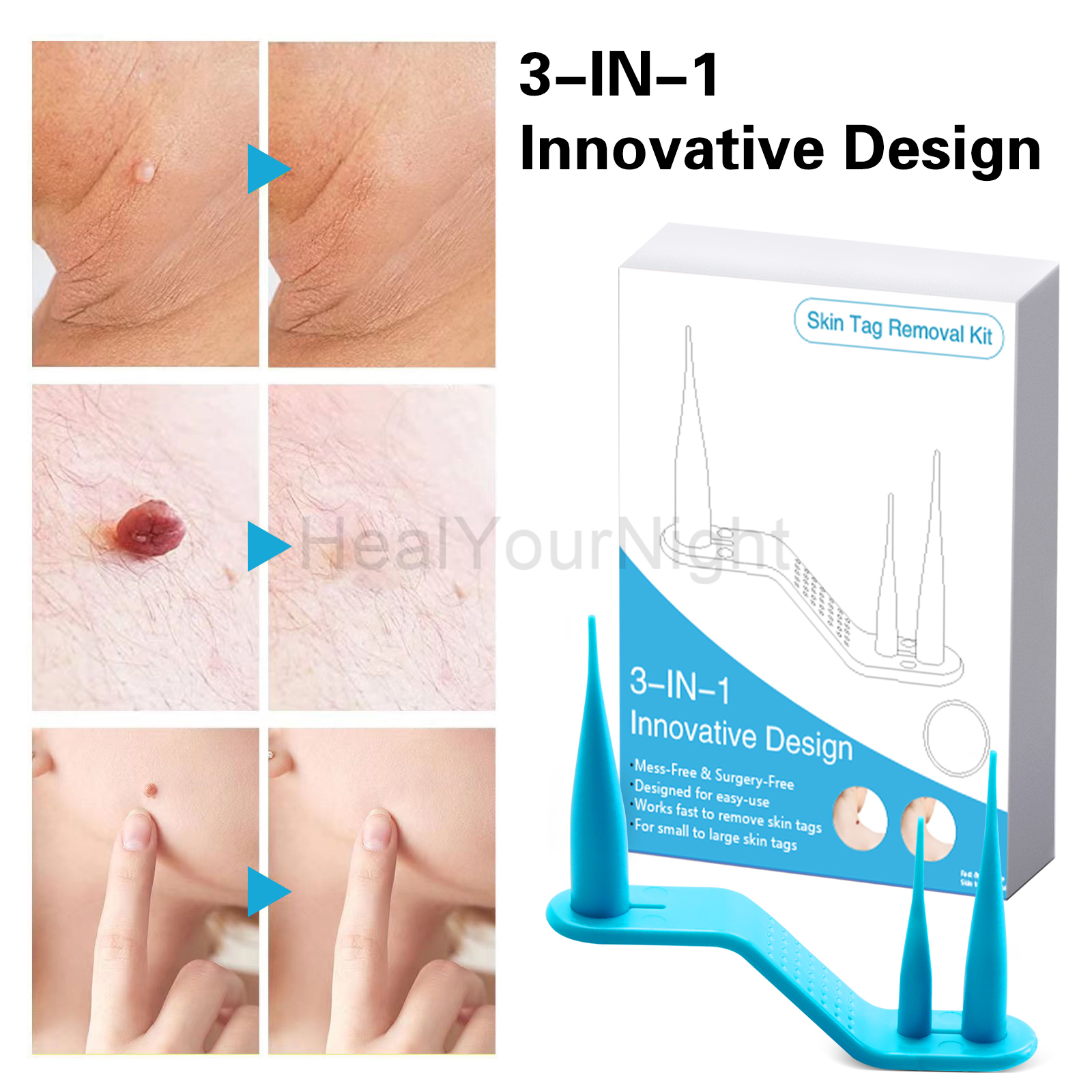3-IN-1 Auto Skin Tag Removal K – Acne Light Therapy Pen Bewertung und Preis