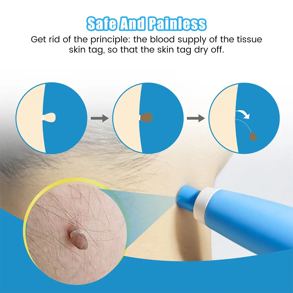 Auto Skin Tag Removal Tool Kit – Acne Light Therapy Pen Bewertung und Preis