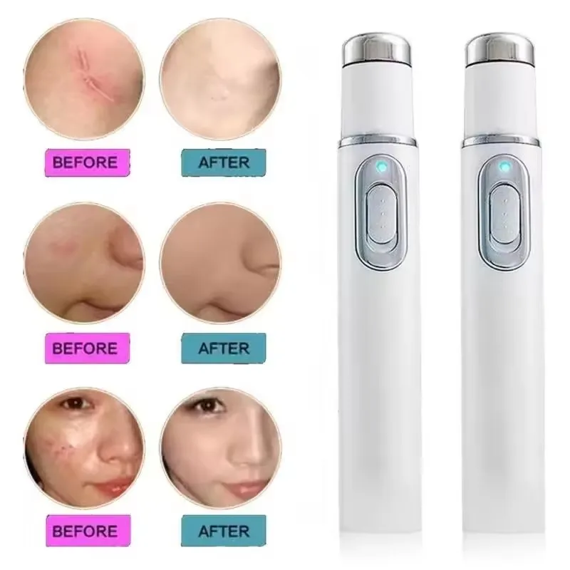 Blue Light Therapy Acne Pen Ey – Acne Light Therapy Pen Bewertung und Preis